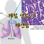 폐암 선암 1기 폐선암